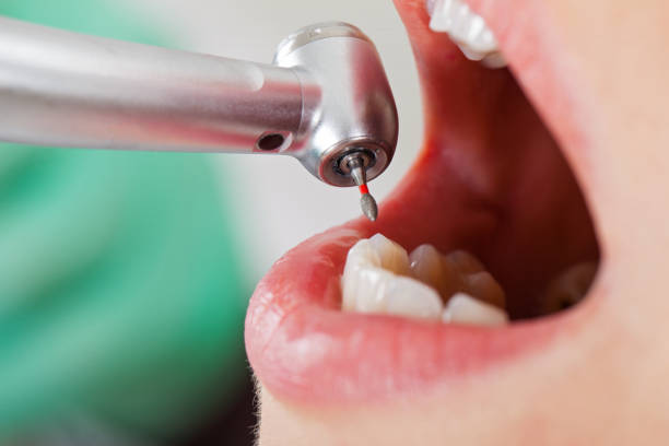 Best Emergency Dentist for Lost Fillings or Crowns in Oakbrook Terrace, IL